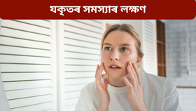 যকৃতৰ সমস্যা হ'লে ছালে দিয়ে এই ৬টা সংকেত! জানক...