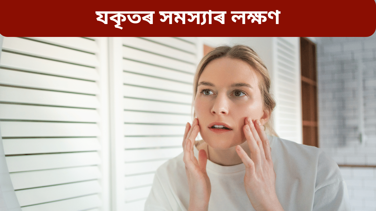 Liver: যকৃতৰ সমস্যা হলে ছালে দিয়ে এই ৬টা সংকেত! জানক... Liver: যকৃতৰ সমস্যা হলে ছালে দিয়ে এই ৬টা সংকেত! জানক...