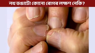 বাৰে বাৰে নখ ভাঙি যায় নেকি? ই কি ৰোগৰ লক্ষণ জানক