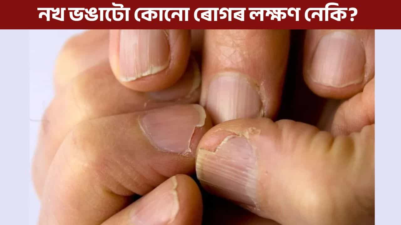 বাৰে বাৰে নখ ভাঙি যায় নেকি? ই কি ৰোগৰ লক্ষণ জানক