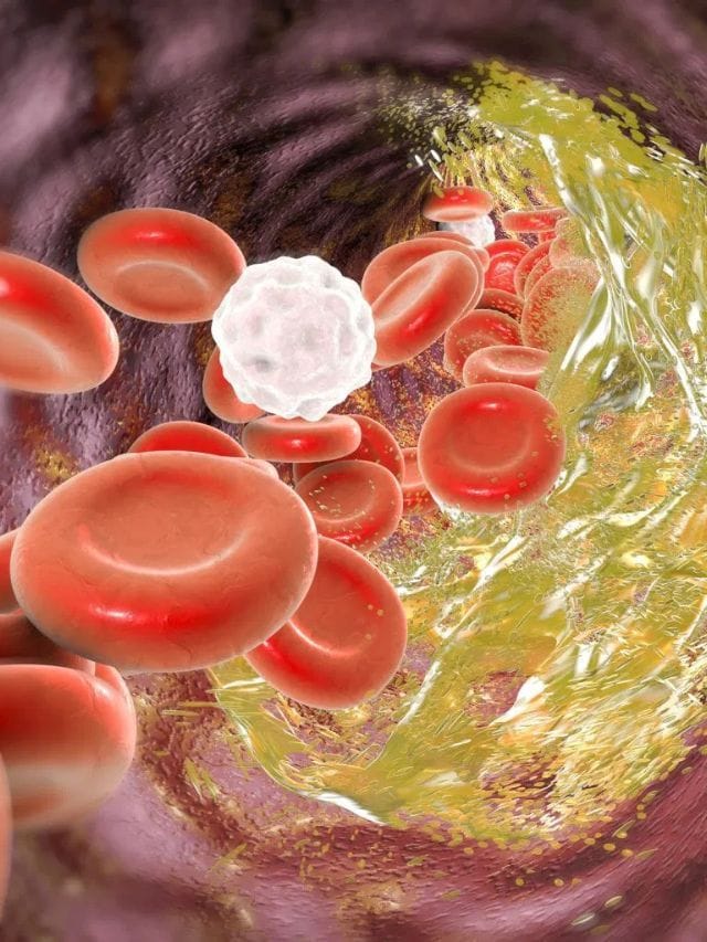 কি কি কাৰণত বেয়া কলেষ্টেৰল বৃদ্ধি পাব পাৰে ? কেনেকৈ কৰিব নিয়ন্ত্ৰণ ?