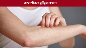 শৰীৰত বেয়া কলেষ্টেৰল বৃদ্ধি পালে কি কি লক্ষণে দেখা দিয়ে? জানক...