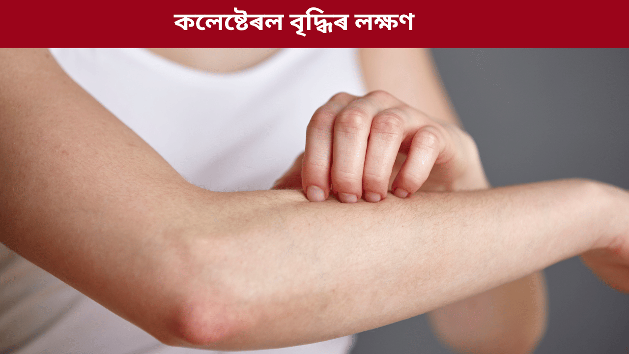 Cholesterol: শৰীৰত বেয়া কলেষ্টেৰল বৃদ্ধি পালে কি কি লক্ষণে দেখা দিয়ে? জানক চিকিৎসকৰ পৰা... Cholesterol: শৰীৰত বেয়া কলেষ্টেৰল বৃদ্ধি পালে কি কি লক্ষণে দেখা দিয়ে? জানক চিকিৎসকৰ পৰা...