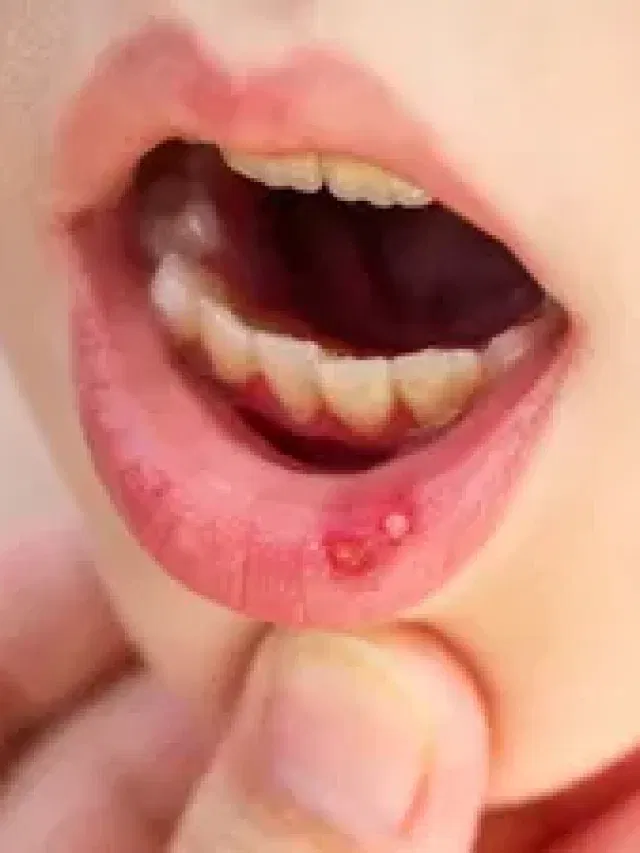 বাৰে বাৰে মুখত ঘাঁ হয় নেকি? কাৰণ, প্ৰতিকাৰৰ উপায় জানক…