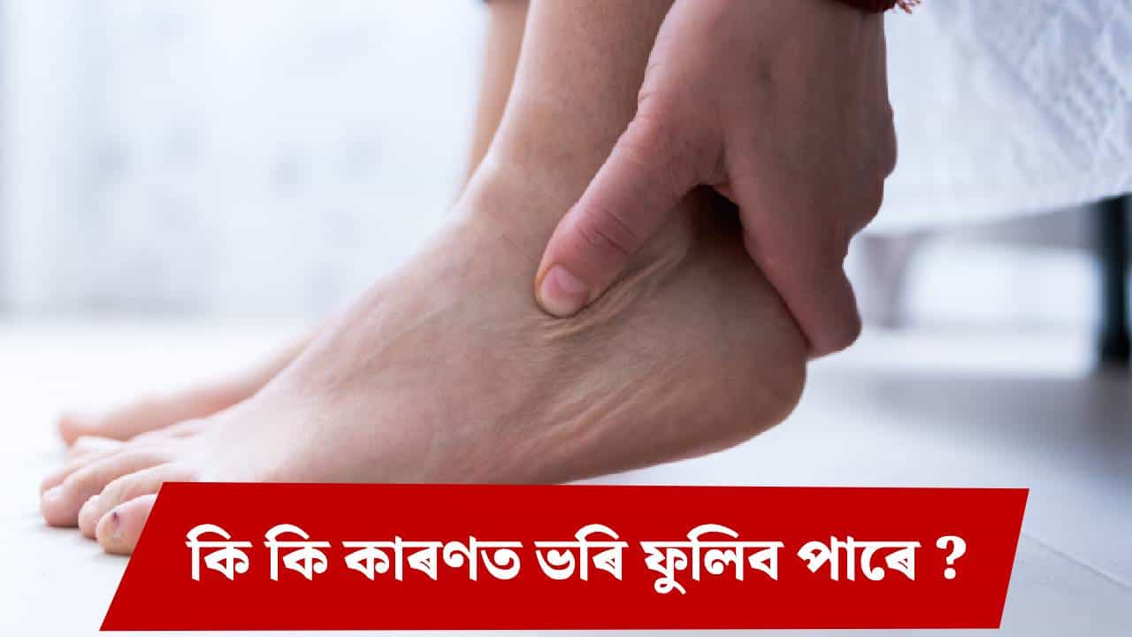 ভৰি ফুলাৰ কাৰণ কি আৰু ই কিমান বিপদজনক? চিকিৎসকৰ পৰা জানক...