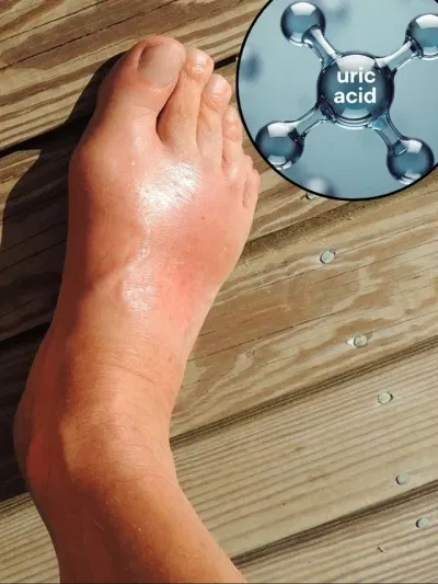 এইবোৰ খাদ্যই বৃদ্ধি কৰে ইউৰিক এচিড, জানক…