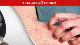 Diabetes: ডায়েবেটিছ হ’লে ছালত কি কি লক্ষণে দেখা দিয়ে? জানক চিকিৎসকৰ পৰা…