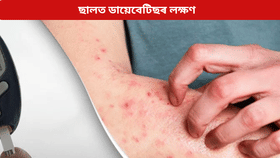 Diabetes: ডায়েবেটিছ হ’লে ছালত কি কি লক্ষণে দেখা দিয়ে? জানক চিকিৎসকৰ পৰা…...