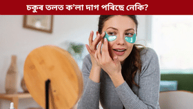 চকুৰ তলত ক'লা দাগ পৰা কি ৰোগৰ লক্ষণ? জানক চিকিৎসকৰ পৰা...