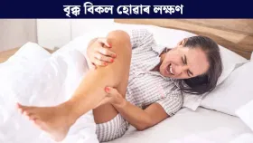 বৃক্ক বিকল হ’লে প্ৰথমে ভৰিত দেখা দিয়ে এইসমূহ লক্ষণে? জানক…...