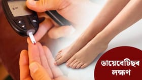 শীতকালত ভৰি ঠাণ্ডা হৈ থকাতো ডায়েবেটিছৰ লক্ষণ নেকি? জানক চিকিৎসকৰ পৰা…...
