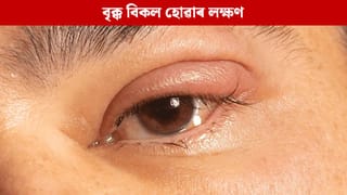 বৃক্ক বিকল হোৱাৰ পূৰ্বে চকুত দেখা দিয়ে এই ৬ টা লক্ষণ, জানক…
