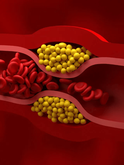 শৰীৰত বেয়া কলেষ্টেৰল বৃদ্ধি হ’লে কি ৫টা লক্ষণে দেখা দিয়ে? জানক…