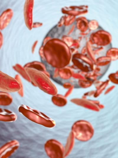 ৰক্তহীনতা কিয় হয় ? শৰীৰত তেজৰ অভাৱ দূৰ কৰাৰ ঘৰুৱা উপায় জানক