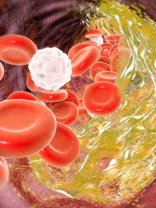 শৰীৰত বেয়া কলেষ্টেৰল বৃদ্ধি হ’লে কি কি লক্ষণে দেখা দিয়ে? জানক..