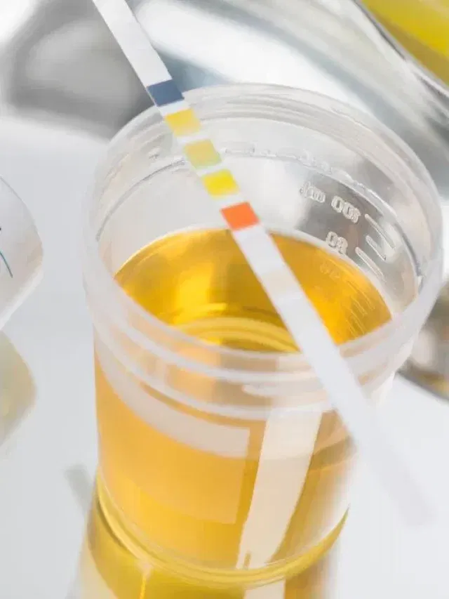 সলনি হৈছে নেকি প্ৰস্ৰাৱৰ ৰং? এয়া কি ৰোগৰ লক্ষণ জানক…