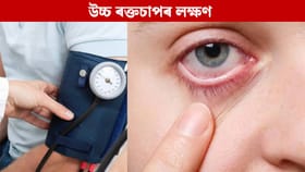 ৰক্তচাপ বৃদ্ধি হ'লে প্ৰথমে চকু দেখা দিয়ে এইসমূহ লক্ষণ, জানক...