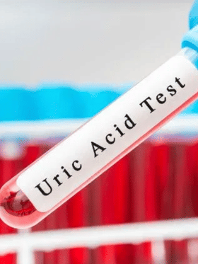 ইউৰিক এচিড নিয়ন্ত্ৰণ কৰাৰ ৫টা ঘৰুৱা উপায়...