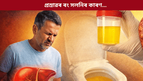 প্ৰস্ৰাৱৰ ৰং সলনি যকৃত ক্ষতিৰ লক্ষণ নেকি? চিকিৎসকৰ পৰা জানক